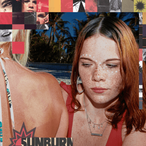 sunburn